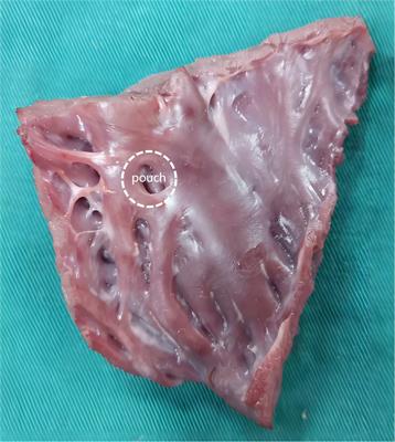 Electro-characteristics of Myocardial Pouches and Reduction of the Frequency of Steam <mark class="highlighted">Pops</mark> During Radiofrequency Ablation
